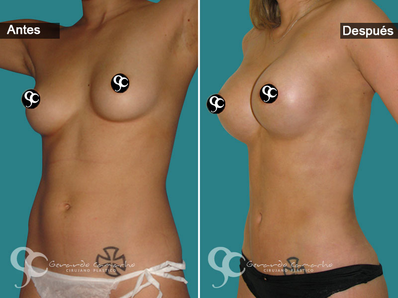 Testimonio lipolisis vaser Colombia